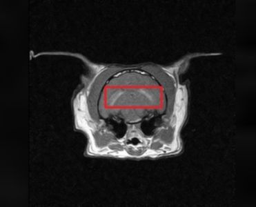 neurologie-Hippocampale-Nekrose