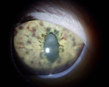 vordere-uveitis