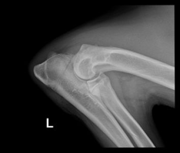 Zustand 12 Wochen nach Entfernung der Implantate