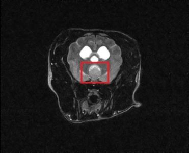 neurologie-Hypophysentumor