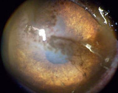 ueberreiterkeratitis