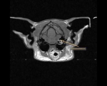 Neuritis-N.-vestibulocochlearis