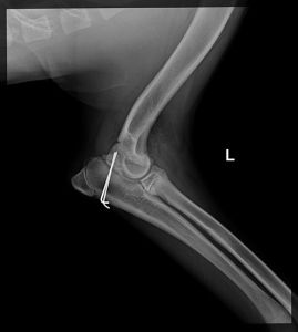 Zustand nach Fixation mittels Bohrdrähten