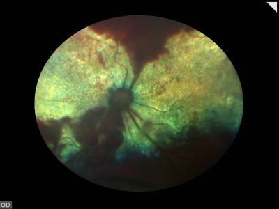 hypertensive-retinopathie