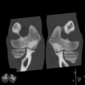 Osteochondrosis dissecans