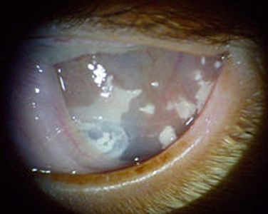 eosinophile-keratitis